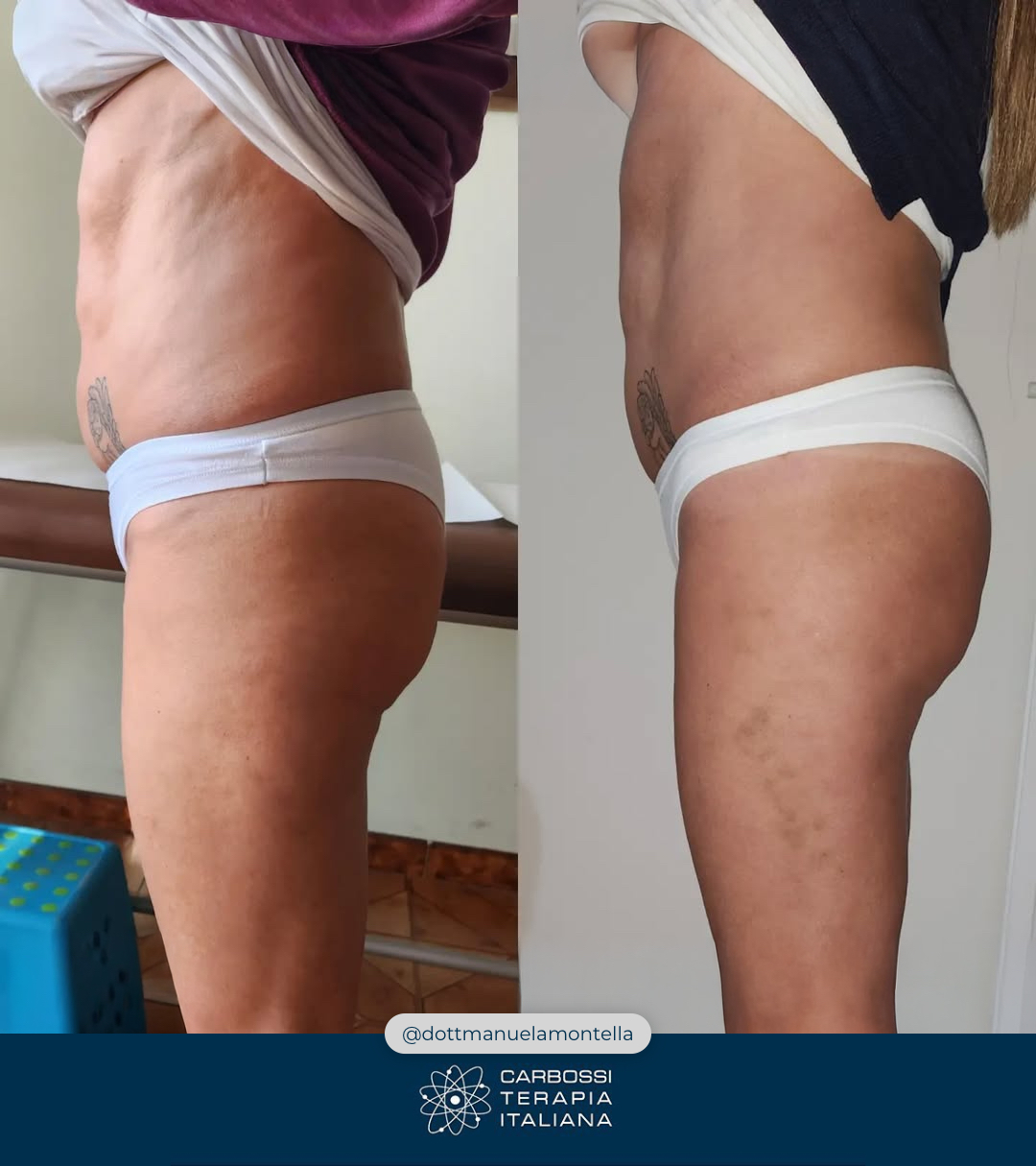 Un altro eccellente lavoro svolto dalla nostra cara @dottemanuelamontella, che grazie all’utilizzo della nostra #Carbossiterapia (e al supporto di alimentazione e movimento) è riuscita in 5 sedute a donare alla sua paziente un risultato eccellente! 🦵🍊Visitate il suo profilo per poter ammirare altri suoi lavori 👉 https://www.facebook.com/dottemanuelamontellaNon avete ancora introdotto la Carbossiterapia nel vostro studio? Contattateci: vi si aprirà un mondo di possibilità per la bellezza e la salute dei vostri pazienti!#CarbossiterapiaItaliana***#provacostume #dottssaemanuelamontella #belle #gambe #avellino #medicina #medicinaestetica