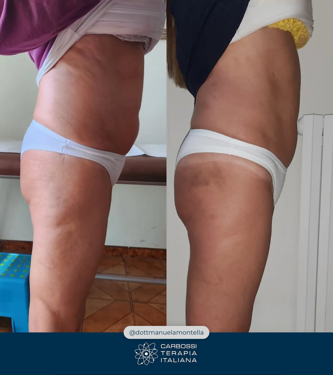 Un altro eccellente lavoro svolto dalla nostra cara @dottemanuelamontella, che grazie all’utilizzo della nostra #Carbossiterapia (e al supporto di alimentazione e movimento) è riuscita in 5 sedute a donare alla sua paziente un risultato eccellente! 🦵🍊Visitate il suo profilo per poter ammirare altri suoi lavori 👉 https://www.facebook.com/dottemanuelamontellaNon avete ancora introdotto la Carbossiterapia nel vostro studio? Contattateci: vi si aprirà un mondo di possibilità per la bellezza e la salute dei vostri pazienti!#CarbossiterapiaItaliana***#provacostume #dottssaemanuelamontella #belle #gambe #avellino #medicina #medicinaestetica