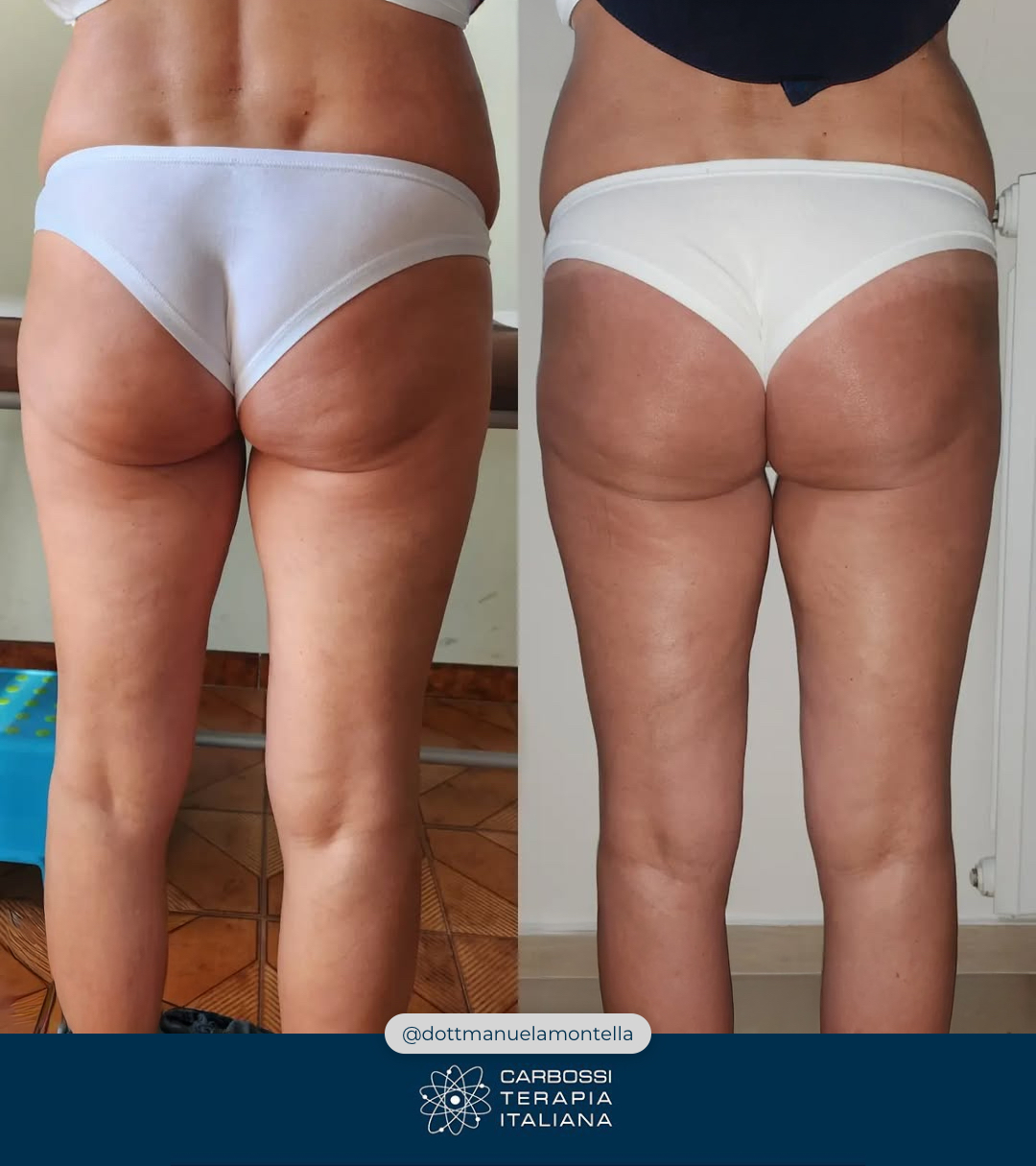Un altro eccellente lavoro svolto dalla nostra cara @dottemanuelamontella, che grazie all’utilizzo della nostra #Carbossiterapia (e al supporto di alimentazione e movimento) è riuscita in 5 sedute a donare alla sua paziente un risultato eccellente! 🦵🍊Visitate il suo profilo per poter ammirare altri suoi lavori 👉 https://www.facebook.com/dottemanuelamontellaNon avete ancora introdotto la Carbossiterapia nel vostro studio? Contattateci: vi si aprirà un mondo di possibilità per la bellezza e la salute dei vostri pazienti!#CarbossiterapiaItaliana***#provacostume #dottssaemanuelamontella #belle #gambe #avellino #medicina #medicinaestetica