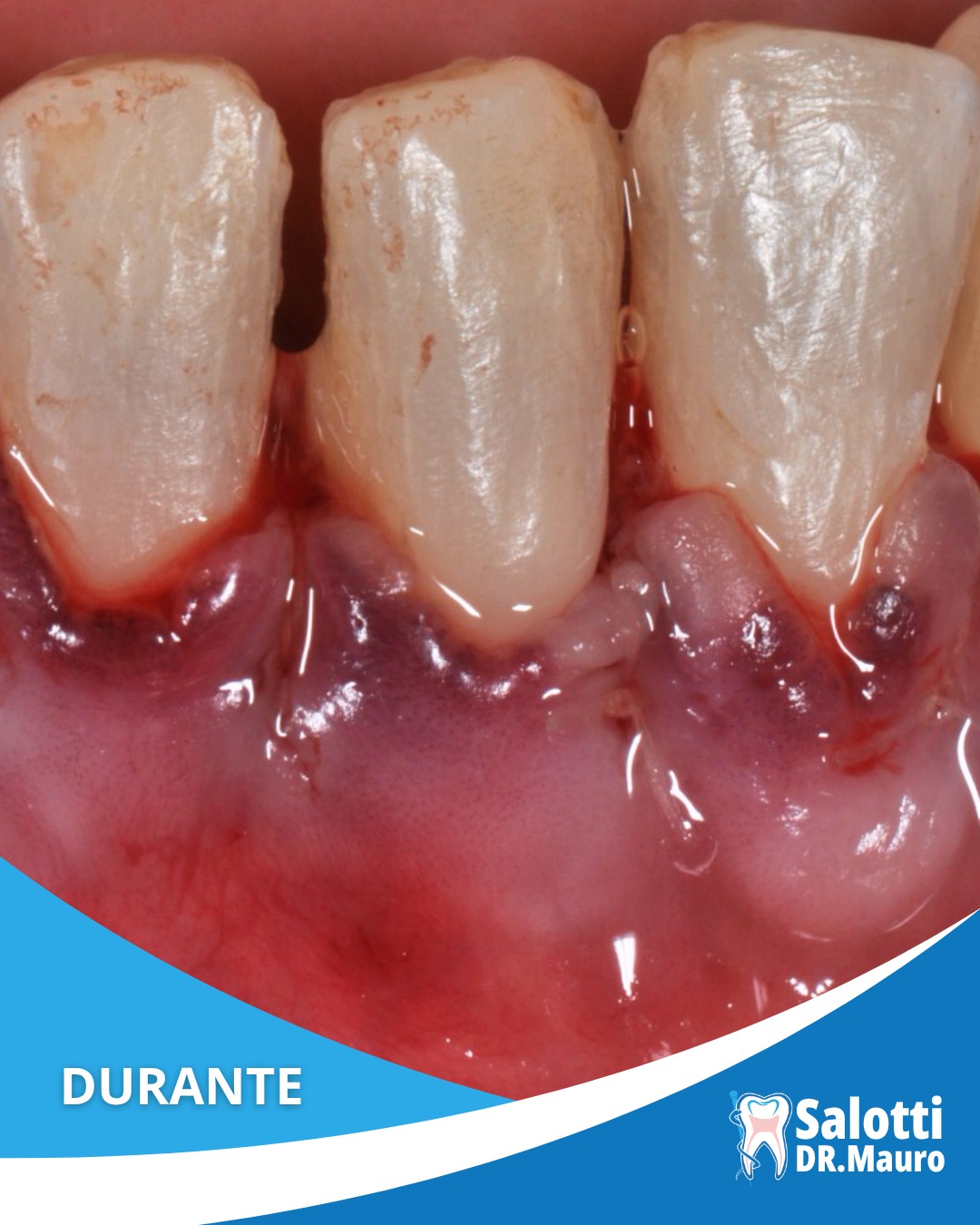 ✨ Un sorriso più sano, armonioso e protetto ✨
In questo caso, la recessione gengivale aveva provocato l'esposizione delle radici dentali, compromettendo non solo l'estetica del sorriso ma anche la protezione naturale dei denti.
🦷 Attraverso un intervento di chirurgia mucogengivale è stato possibile risollevare e riposizionare la gengiva, restituendo una corretta copertura delle radici e un aspetto più naturale al sorriso.
➡️ Nella foto finale, a distanza di alcuni mesi, si può apprezzare il risultato: gengive più armoniose, denti meno "lunghi" e una migliore protezione dei tessuti dentali.
Un trattamento che migliora non solo l'estetica, ma anche la salute e la stabilità del sorriso nel tempo. 💙
📩 Contattaci per una valutazione personalizzata.
#recessionegengivale #chirurgiagengivale #sorriso #trasformazionesorriso #dentista #parodontologia #saluteorale #gengive #odontoiatria #sorrisosano